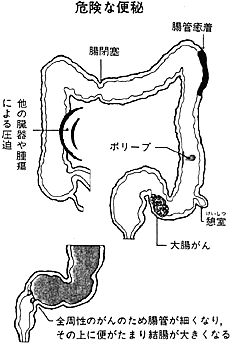 何 危険 便秘 日 「便秘」でためこめるのは、何日まで？ (2008年3月25日)